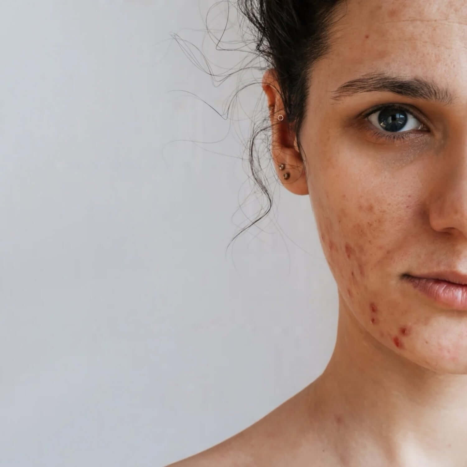 Ragazza con pelle impura e imperfezioni, ideale per cosmetici per pelli impure.